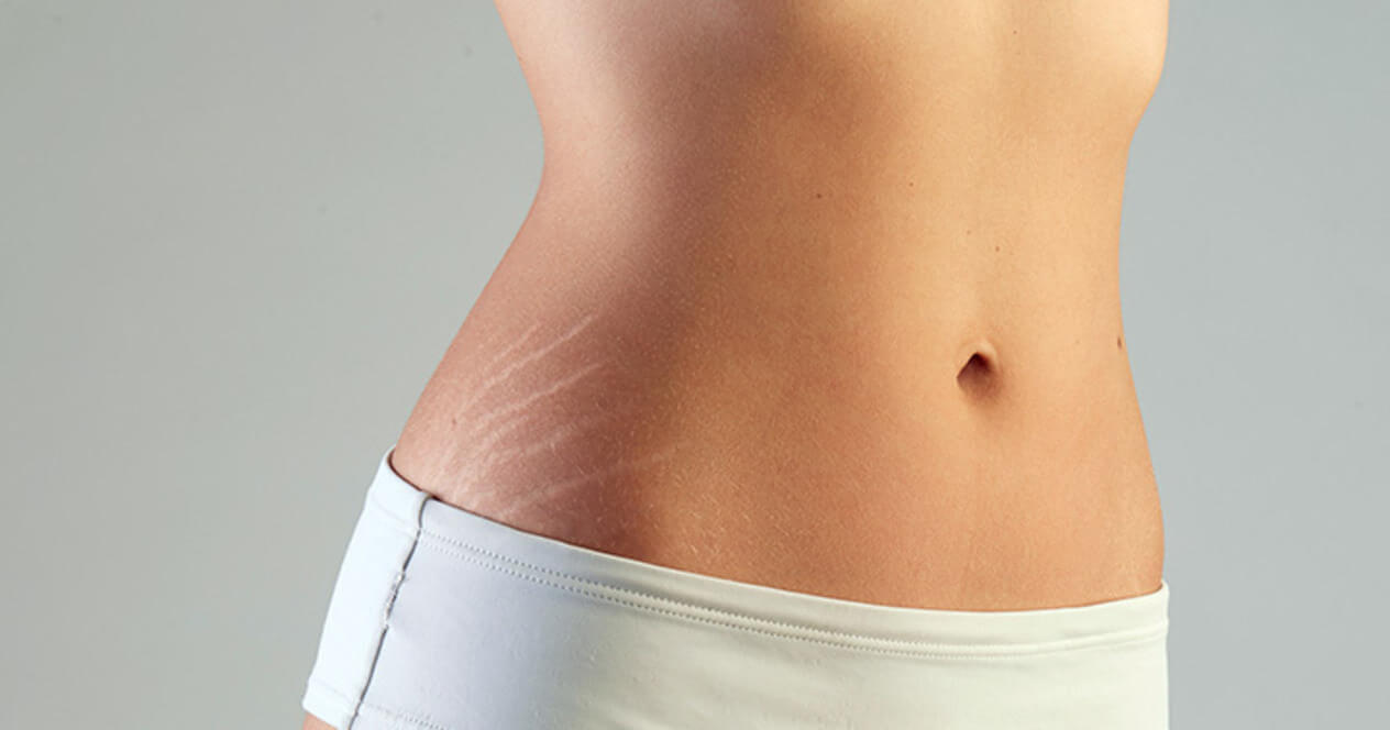 Estrias: saiba como prevenir e tratar