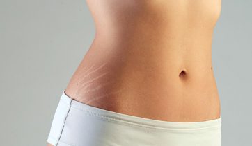 Estrias: saiba como prevenir e tratar