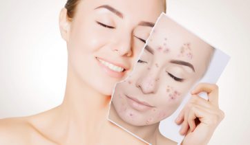 Tratamento natural para Acne